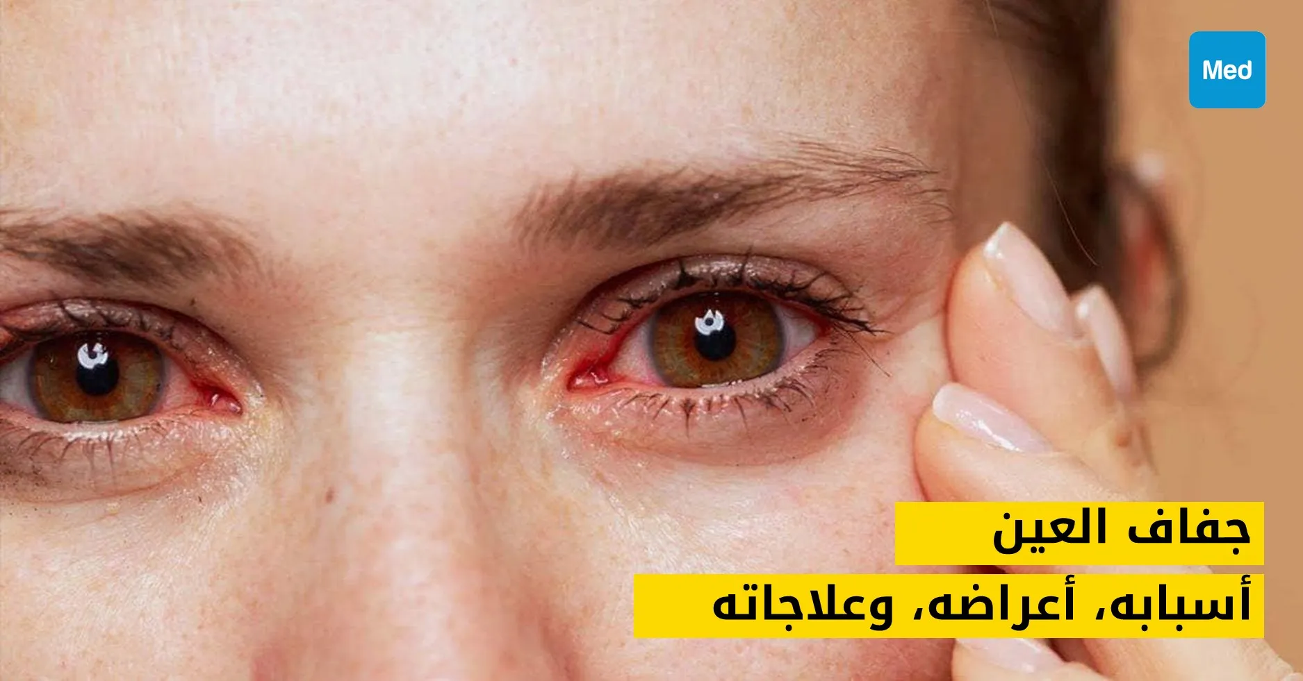 جفاف العين: أسبابه، أعراضه، وعلاجاته